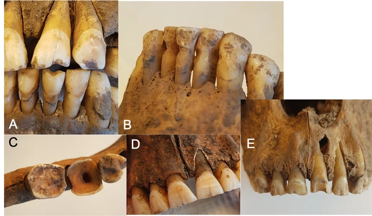 Мучились от боли: как викинги пытались лечить кариес 1000 лет назад?