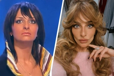 "Unhappy but beautiful": Stars who removed Bichat's fat pads and deeply regretted it