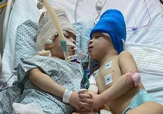 Операция длилась 27 часов: в Бразилии успешно разделили сиамских близнецов — краниопагов