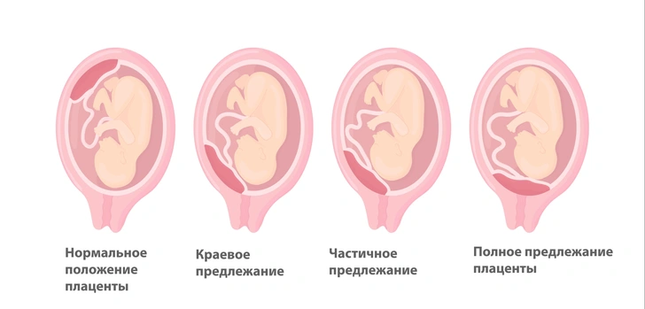 Предлежание плаценты — опасная патология во время беременности: почему возникает и как ее лечить