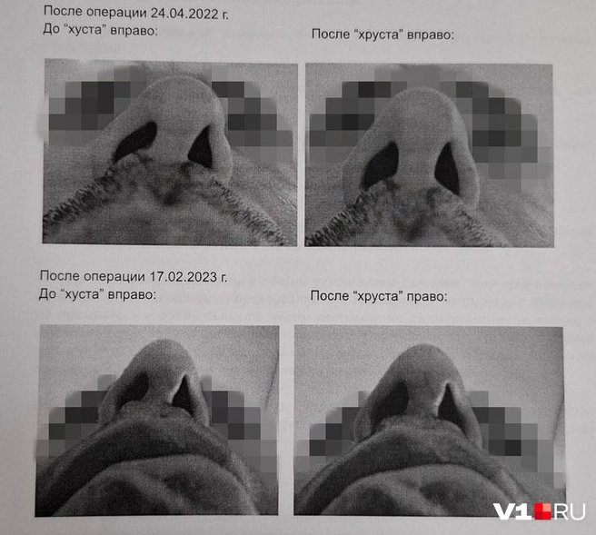 По словам Артема, нос буквально «ходил» из стороны в сторону с видимым шрамом | Источник: Тимофей Крылов, Юрий Скулыбердин / V1.RU