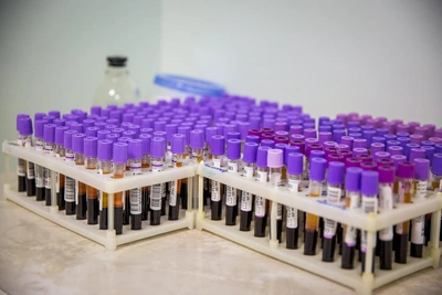 Lipid profile tests added to Novosibirsk medical examinations