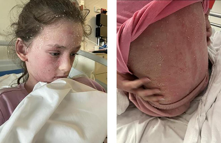 11-летняя девочка отказалась от мечты танцевать из-за редкой аллергии на саму себя