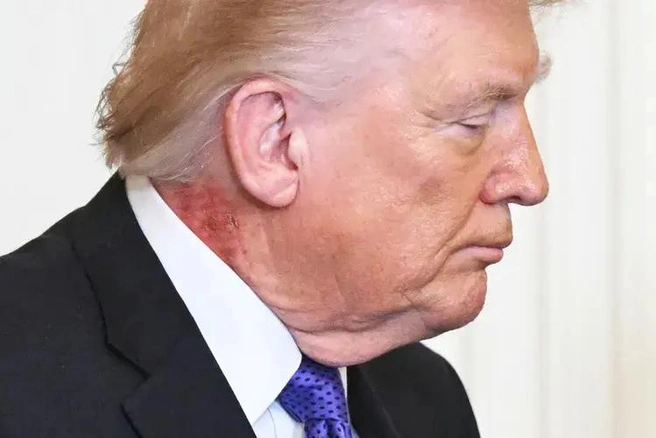 Трамп появился на публике с огромным красным пятном на шее. Белому дому пришлось объяснять | Источник: кадр из трансляции Белого дома
