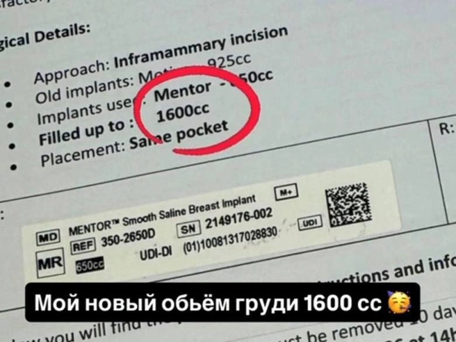 Екатеринбурженка установила импланты экстремального объема | Источник: annushka_da / Instagram.com (соцсеть запрещена на территории РФ)