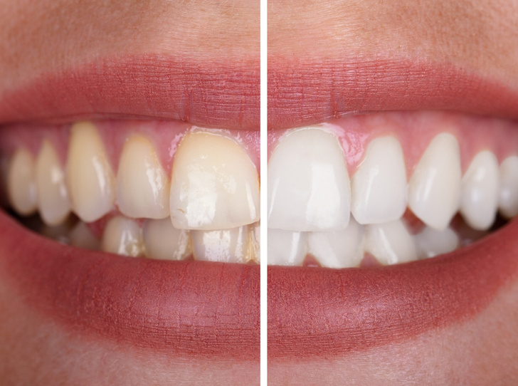 Маркер здоровья: о чем может рассказать цвет зубов