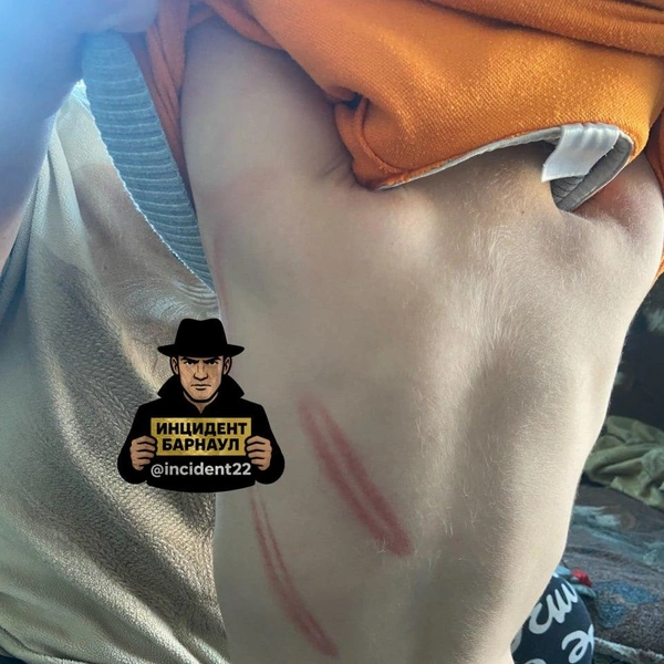 Чем могли избить ребенка&nbsp;— не уточняется | Источник: Инцидент Барнаул