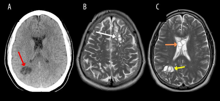 Фото КТ и МРТ пациента. Стрелками показаны поражения мозга.