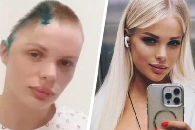 Beaten Moscow model needs skull plate surgery for rehabilitation