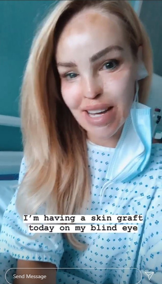 300 операций спустя: Кэти Пайпер, облитая серной кислотой, легла в больницу ради очередной трансплантации кожи