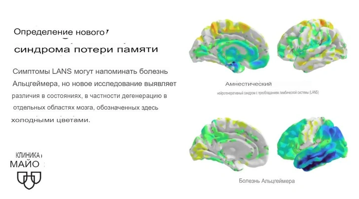 Ученые Мейо раскрыли новый синдром потери памяти, его путают с болезнью Альцгеймера