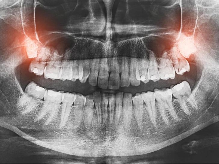 10 фактов о зубах мудрости, которые ты вряд ли знала