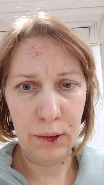 Тюменка получила множественные ушибы мягких тканей головы и лица, ушибы мягких тканей в области поясничного отдела позвоночника и правого предплечья (справка есть в распоряжении 72.RU) | Источник: Оксана Иващенко