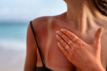 Как лечить солнечные ожоги?