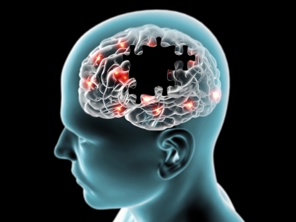 Сотрясения мозга могут вызвать болезнь Альцгеймера
