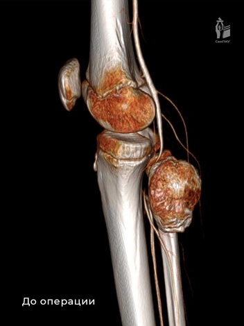 Размеры нароста охарактеризовали, как «гигантские» | Источник: клиники СамГМУ