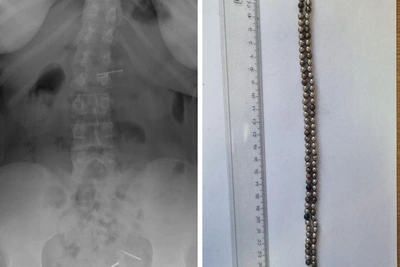 Экстренная операция в Новосибирске: ребенок проглотил 25 магнитов