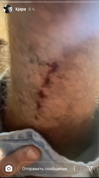 Третья травма за неделю: Кей Джей Апа повредил ногу на съемках фильма «Певчая птица»