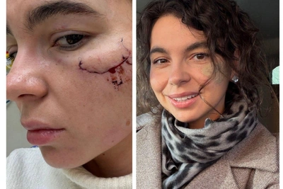 «Мне больно»: королева красоты боится шрама после нападения