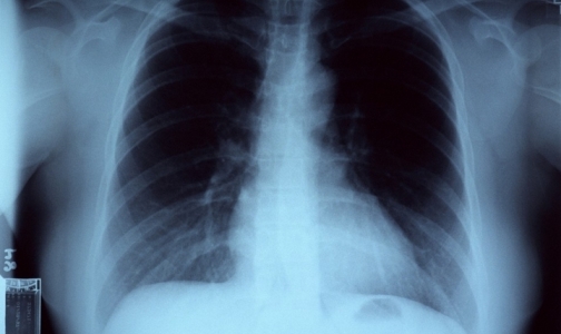 Страдающих туберкулезом хотят изолировать