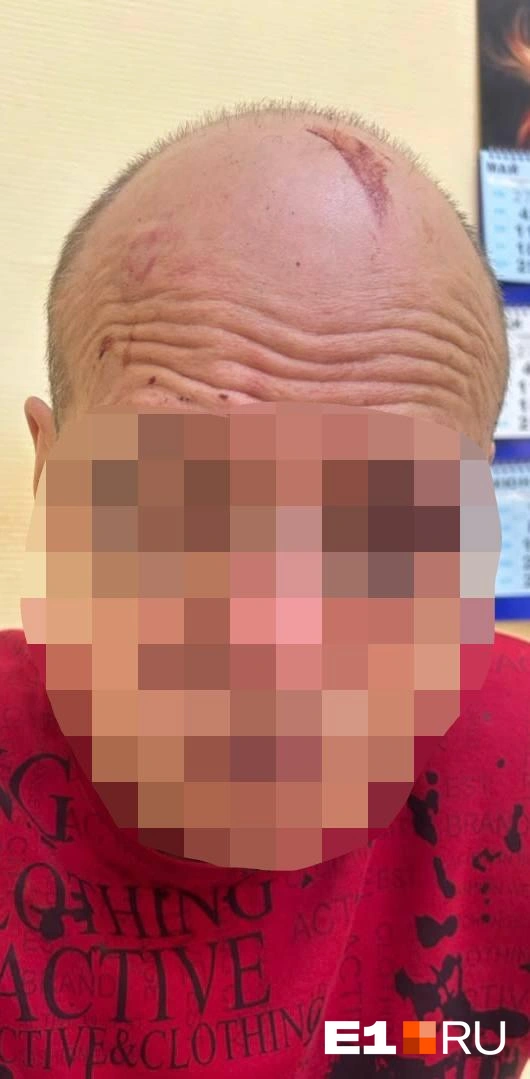 У мужчины под глазами остались синяки | Источник: предоставлено супругой Максима