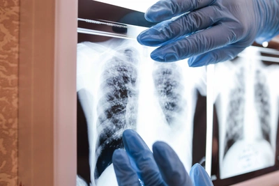 Омич с туберкулезом заразил двоих детей, уклоняясь от лечения