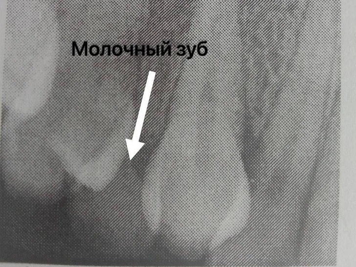 Большая редкость: врачи помогли 24-летней девушке, к которой не приходила зубная фея