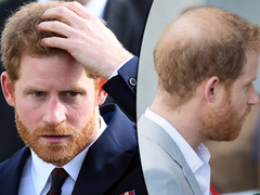 Что редеющие волосы принца Гарри могут рассказать о его отношениях с женой