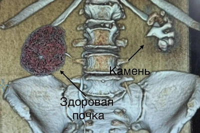 Коралловидный камень потребовал удаления почки у пациентки