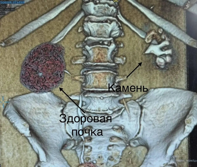 Гигантский «коралл» оставил петербурженку без почки