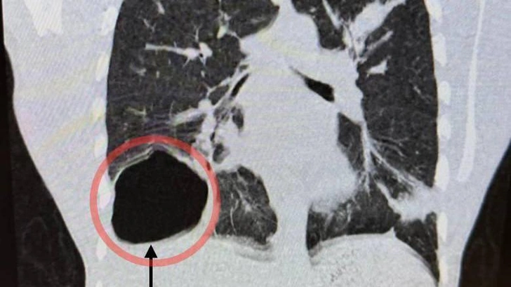В Подмосковье у 17-летнего юноши в легком выросла киста с паразитами размером с голову