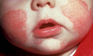 Блеск и нищета детской аллергологии