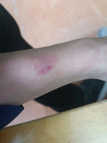 Покусанная рука | Источник: Предоставлено родителями учеников