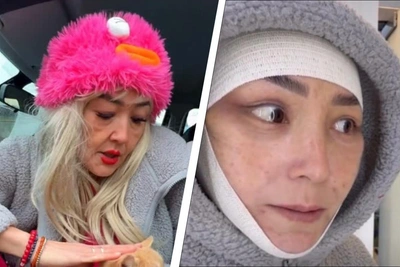 Blogger Shows Face After Facelift, Says 'Thought I'd Kicked the Bucket'