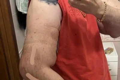 Руки-Базуки пересадил кожу с правого бицепса на левый