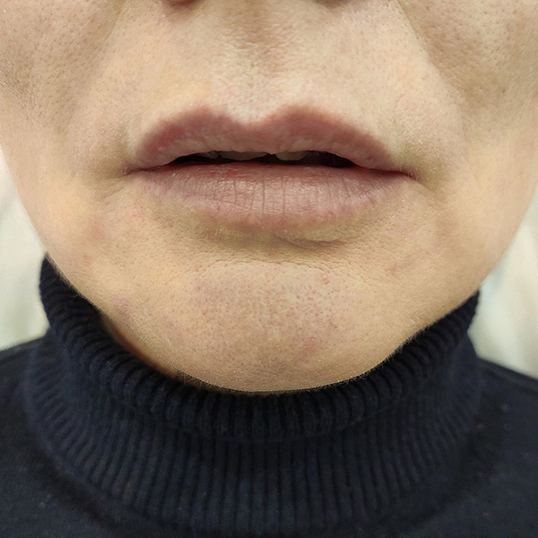 Фото №5 - Как размер губ меняет внешность: 20 фото до и после увеличения