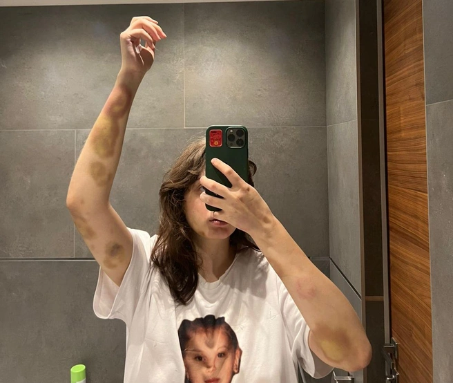 Последствия побоев девушка фиксировала на телефон | Источник: Валерия Васильева