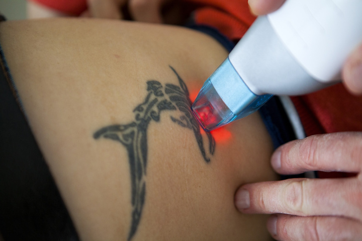 Лазерное удаление татуировки: что стоит знать, прежде чем решиться