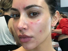 «Вот, что со мной делает болезнь»: Ким Кардашьян показала честное фото без макияжа и с воспалениями на лице