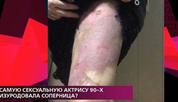 Наталья Лапина обвинила экс-возлюбленную бойфренда в нападении с кислотой