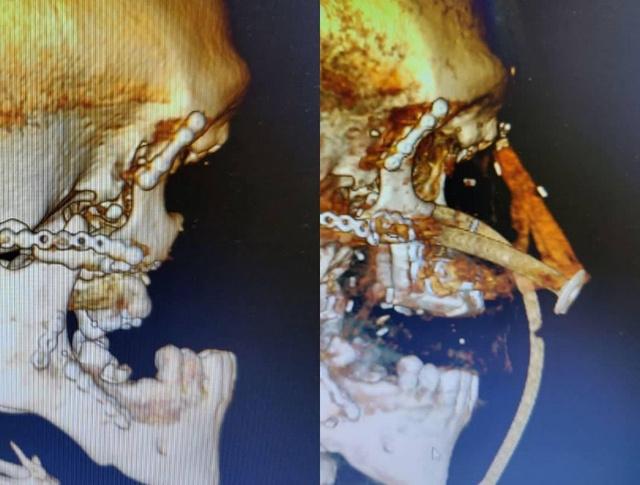 В Минске хирурги пришили мужчине нос, который вырастили у него на руке