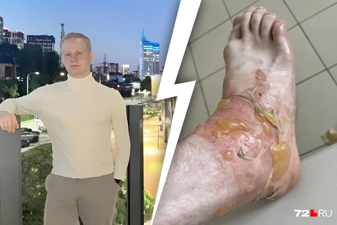 21-летний тюменец получил серьезный ожог и провел в больнице три недели | Источник: Клим Позняковский, коллаж: Дмитрий Гладышев / Городские медиа