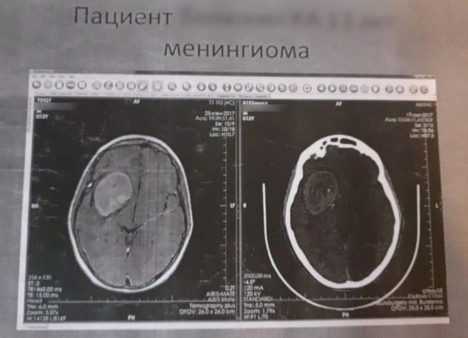 Снимок с опухолью