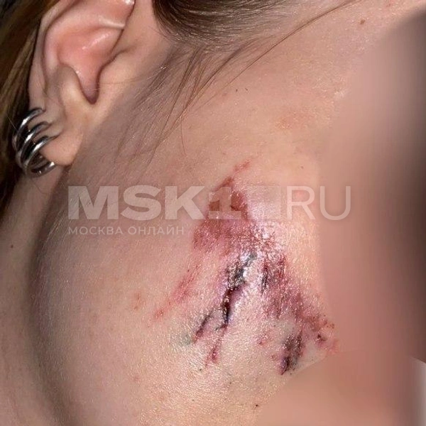По словам Марии, кирпич пришелся на скулу, едва не задев висок | Источник: предоставлено героиней публикации