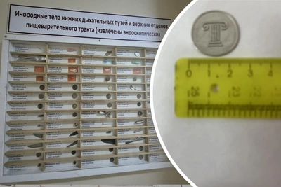 Врачи достали из желудка ребенка монету из акции «Магнита»