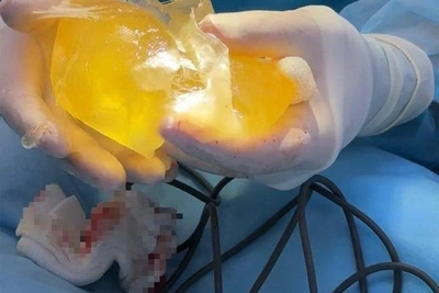 Ufa woman's breast implant bursts after informal enlargement