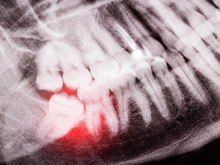 10 фактов о зубах мудрости, которые ты вряд ли знала
