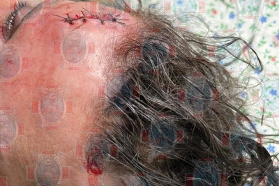 Драка в ставропольском баре: мужчина с тяжёлой травмой головы