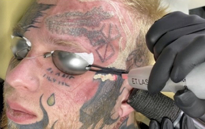 Как выглядит удаление татуировки на лице — такого вы еще не видели