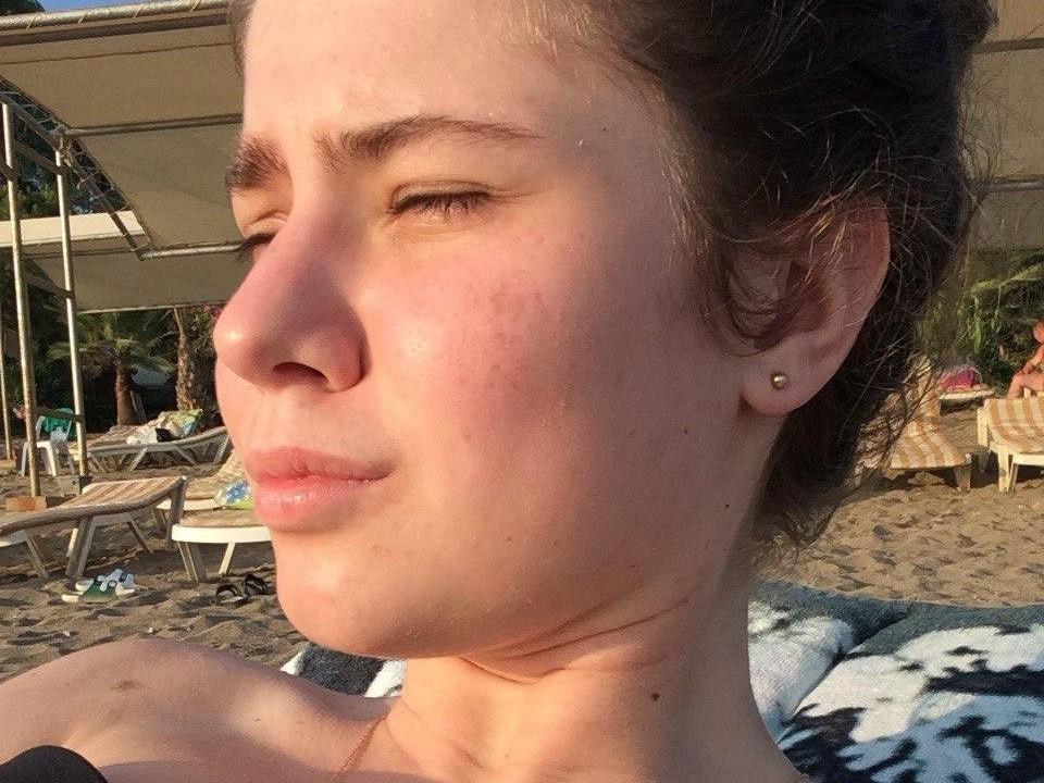 «Хотелось расплакаться»: уфимка рассказала, как шесть лет лечила кожу, а помог психолог